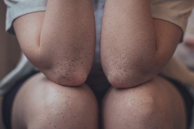 Why are my knees purple?