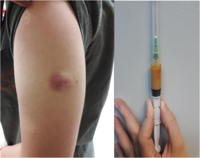 How long should I have a lump in my arm after tetanus sho