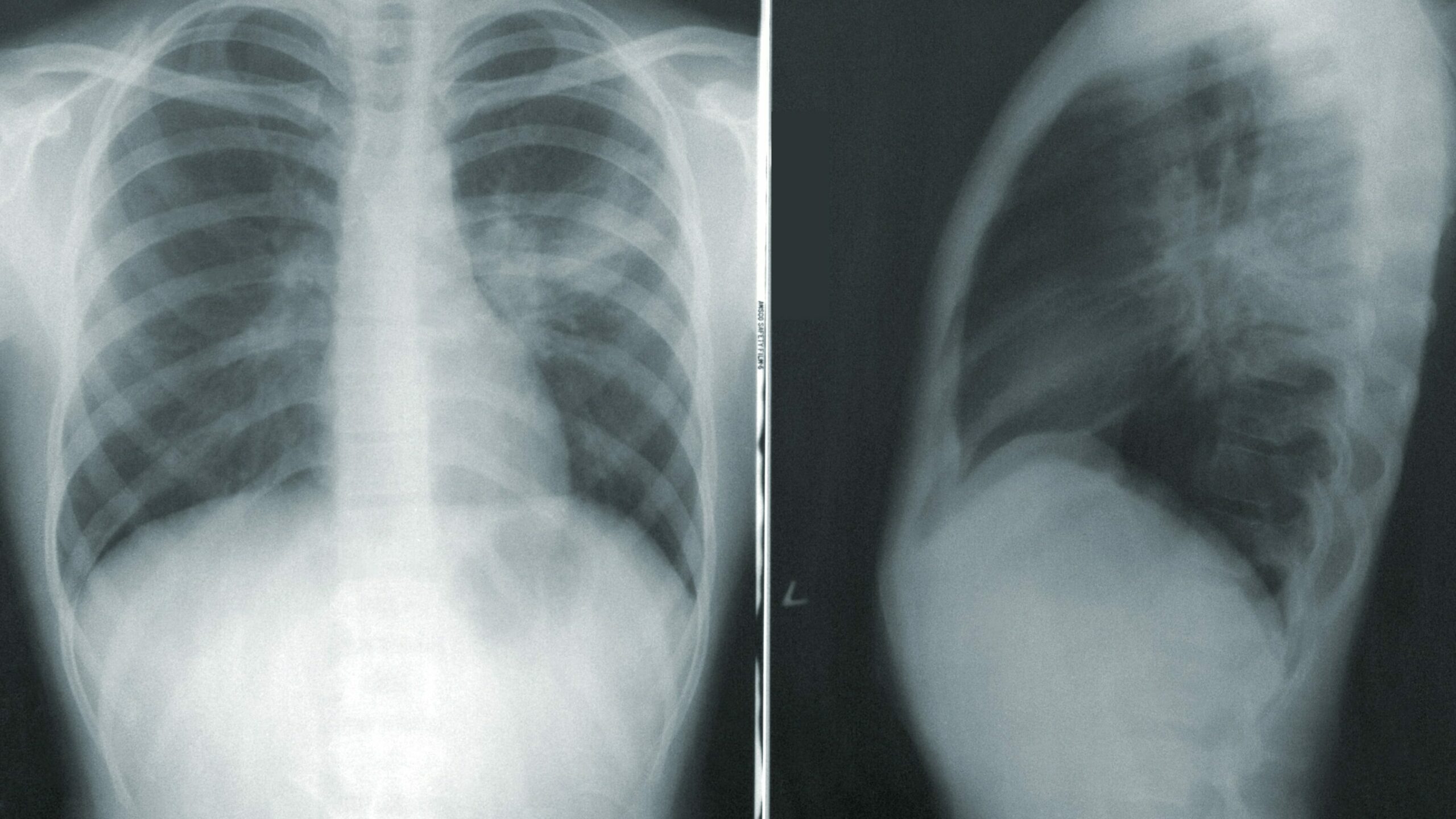 Will Mucinex Help Pneumonia?