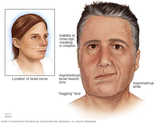 Which celebrity has bells palsy?