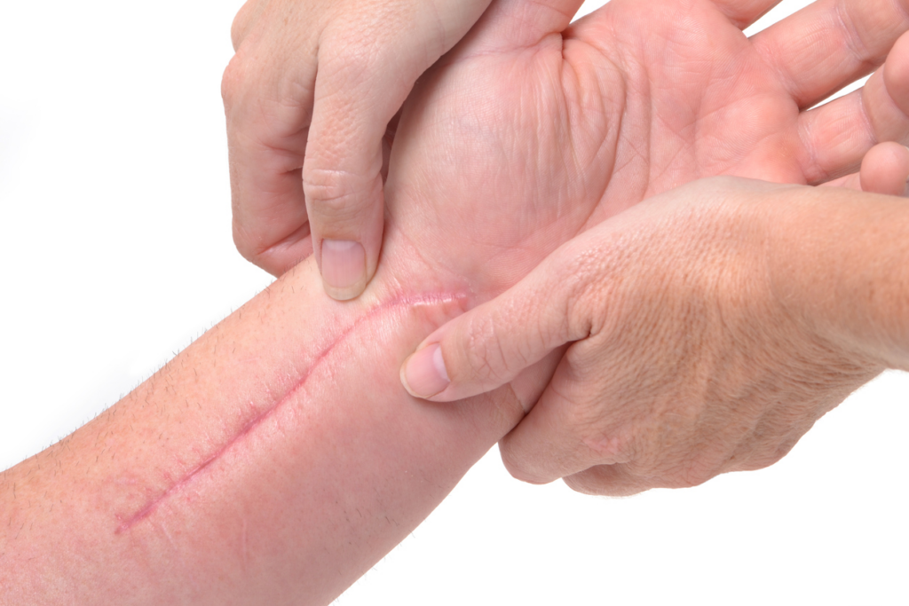 Is it too late to massage a scar?