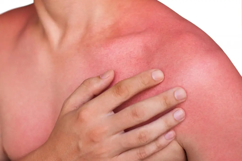Why is my chest always red?