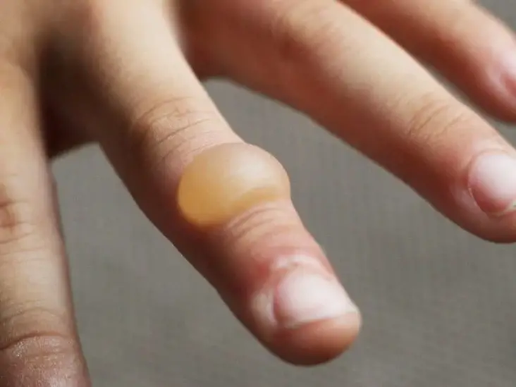 What is the fluid inside the blister?