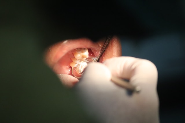 How many cavities is normal for a 30 year old?