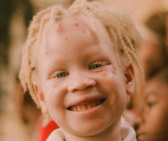 Can humans be the opposite of albino?